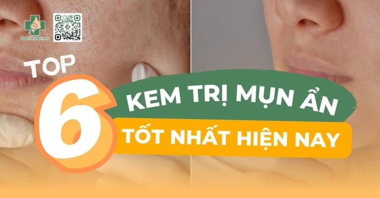 Bí quyết trị mụn ẩn cho da dầu hiệu quả ngay tại nhà