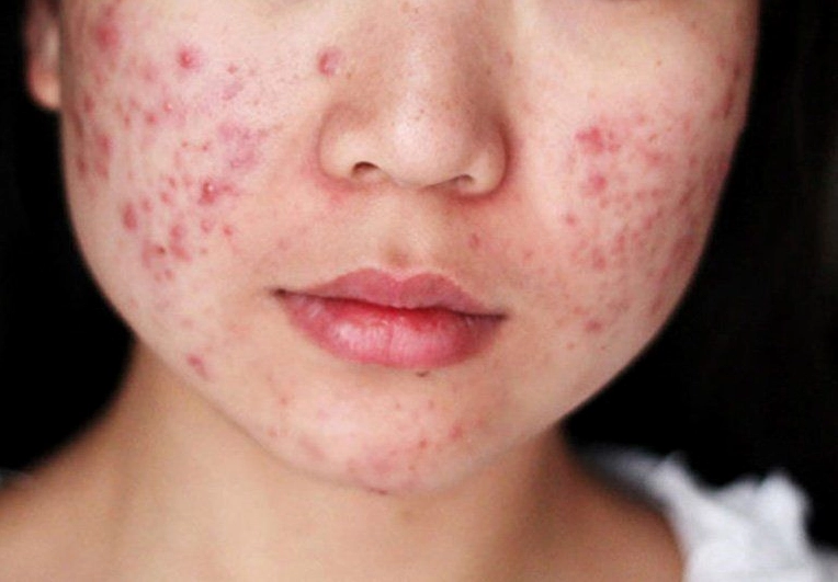 Miếng Dán Mụn Hàn Quốc: Giải Pháp Hiệu Quả Cho Làn Da Sạch Mụn