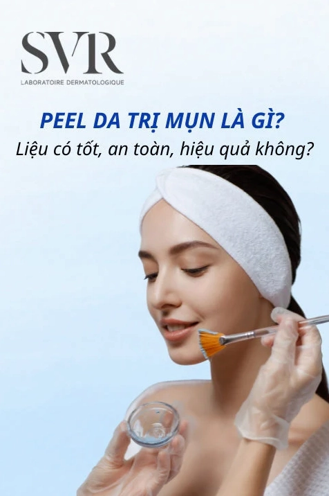 Peel Da Trị Mụn: Giải Pháp Hiệu Quả Hay Rủi Ro Tiềm Ẩn Năm 2026?
